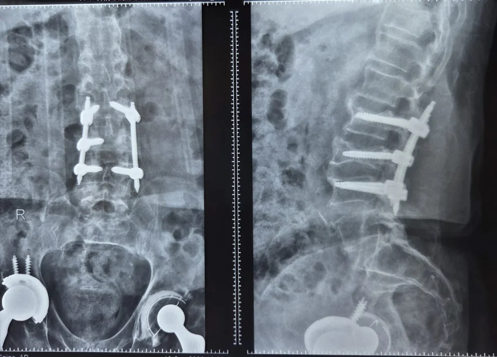 spine