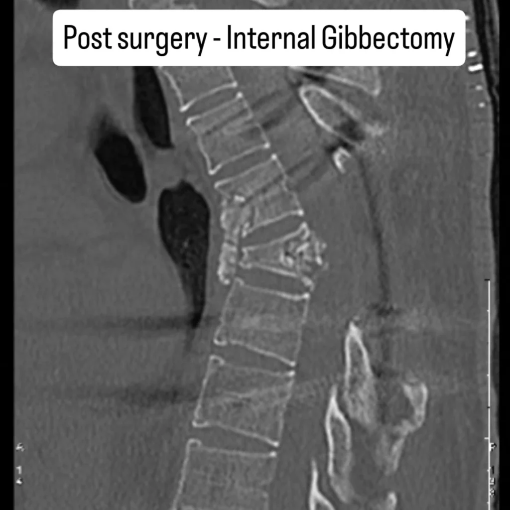 spine surgery